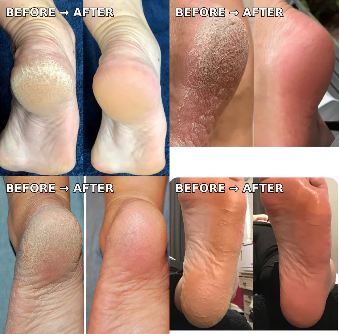 PinkGen Callus Remover ™